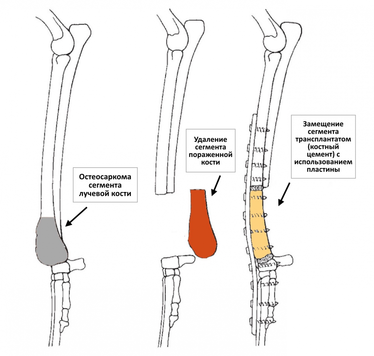 Рецидив кости. Остеосаркома лучевой кости у собак. Операция при остеосаркоме. Краевая резекция кости операции. Остеогенная саркома хирургическое лечение.